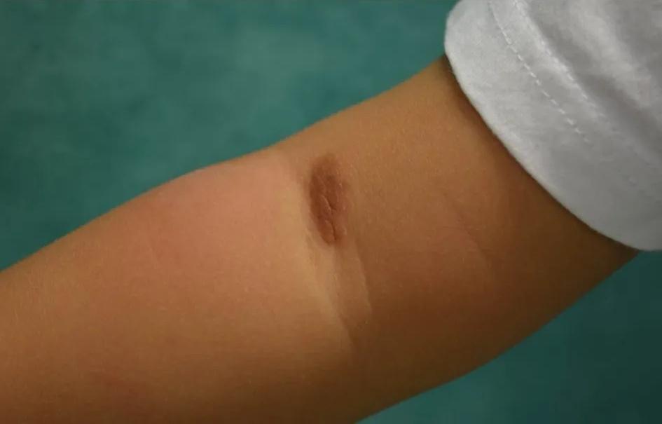Imagen clínica de la pregunta de Dermatología