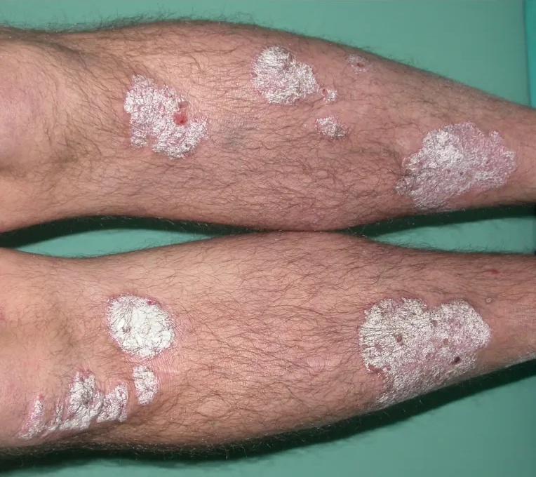 Imagen clínica de la pregunta de Dermatología