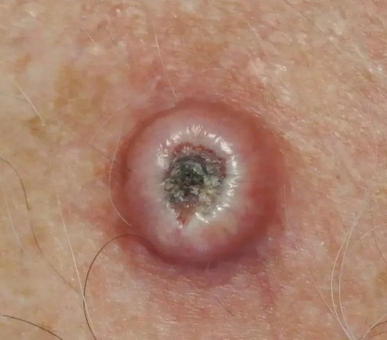 Imagen clínica de la pregunta de Dermatología