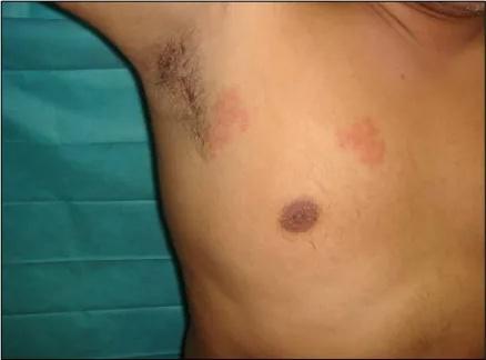 Imagen clínica de la pregunta de Dermatología