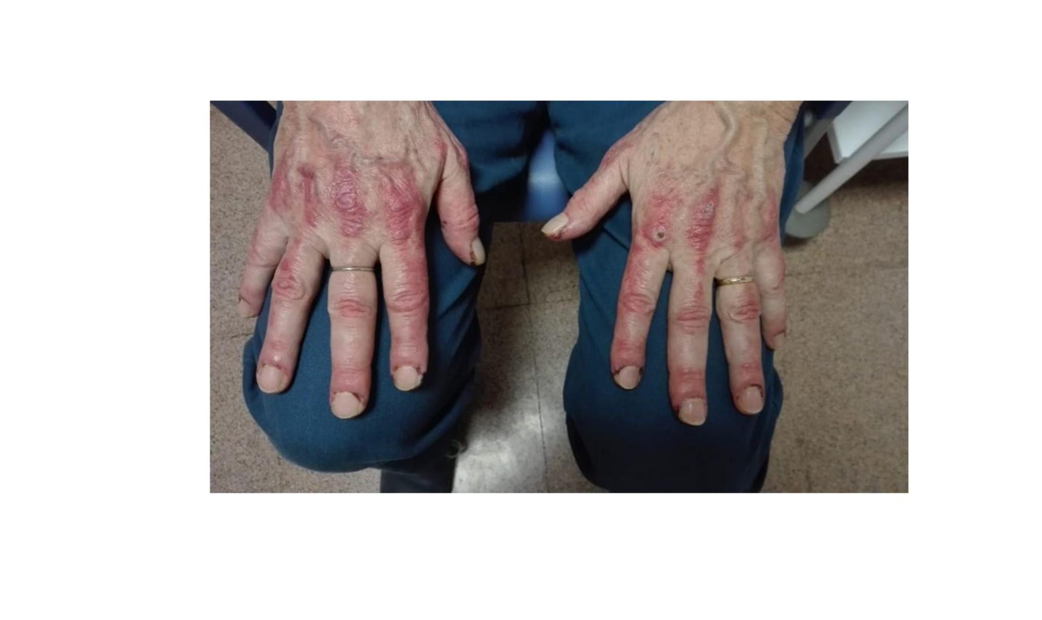 Imagen clínica de la pregunta de Dermatología