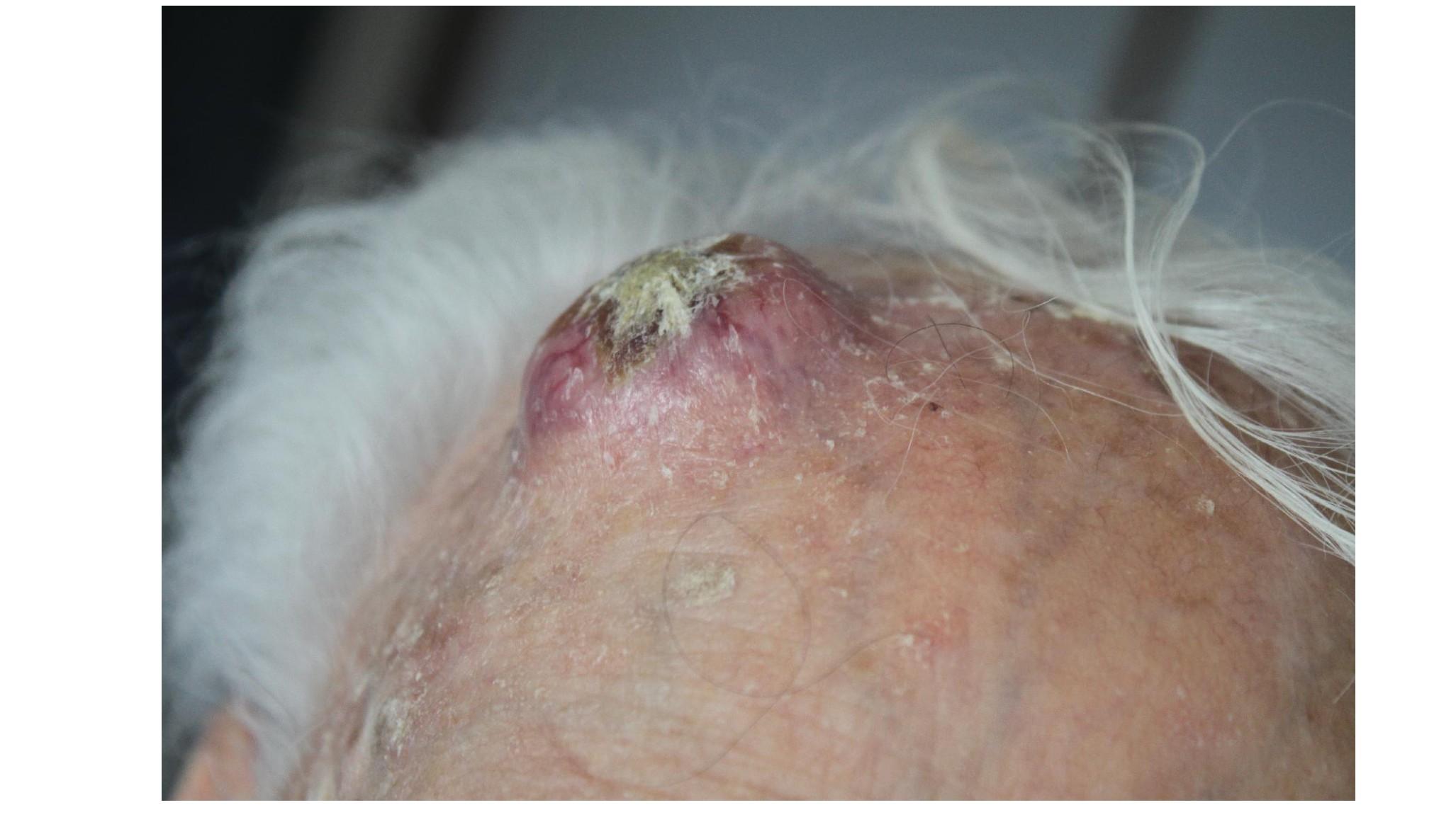 Imagen clínica de la pregunta de Dermatología