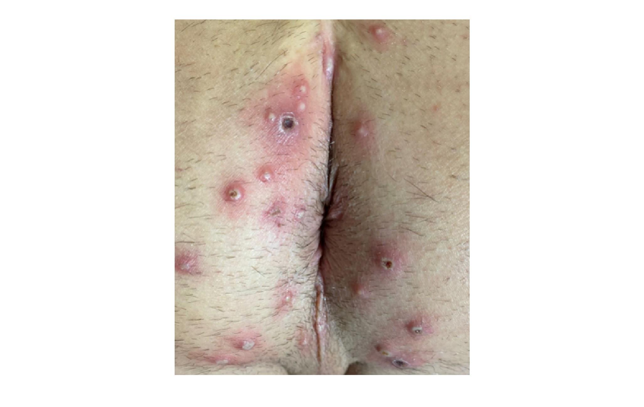 Imagen clínica de la pregunta de Infecciosas