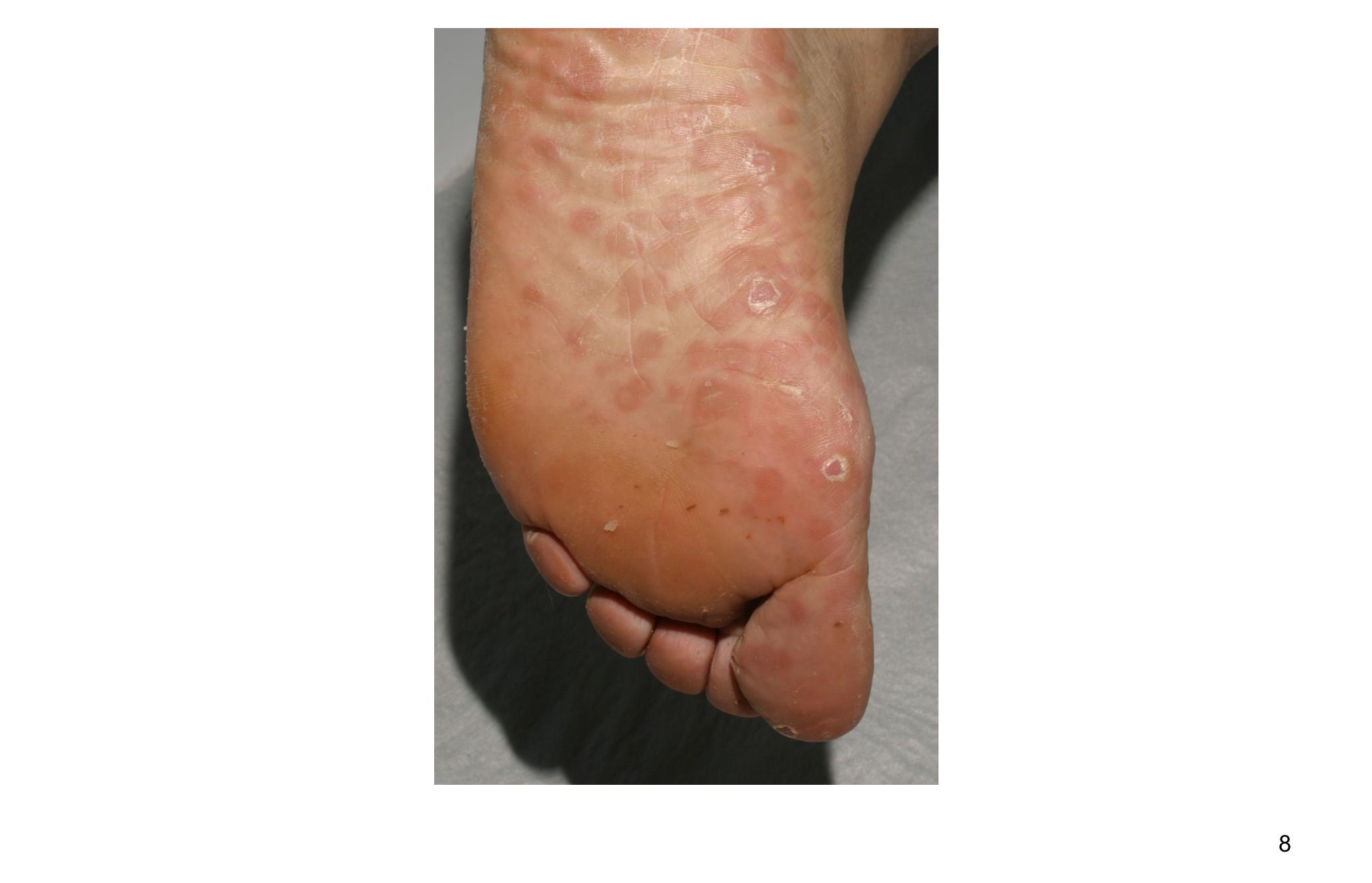 Imagen clínica de la pregunta de Dermatología