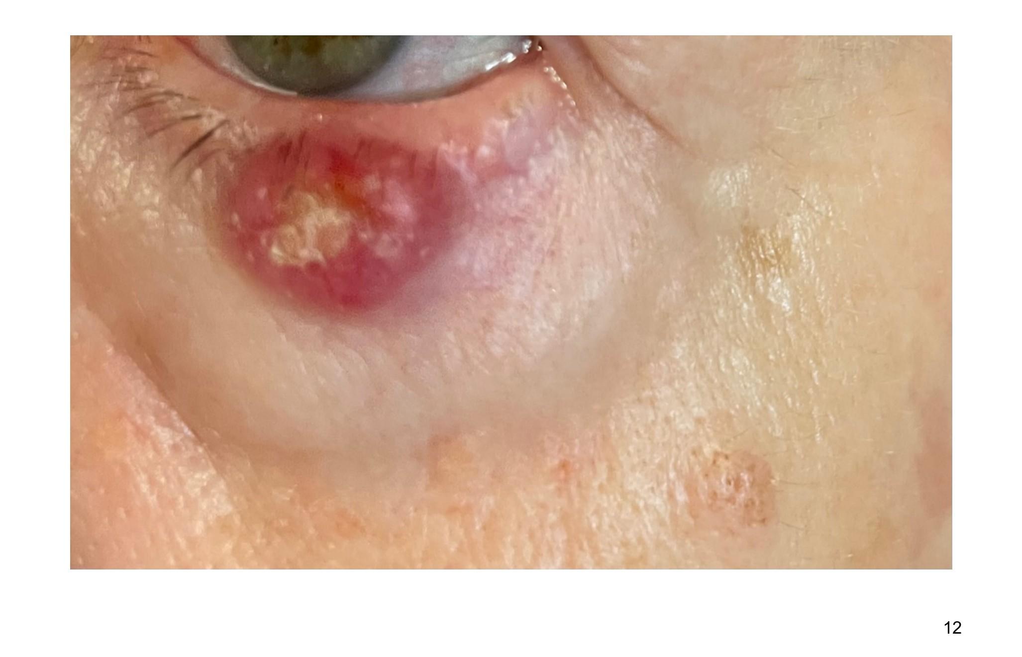 Imagen clínica de la pregunta de Dermatología