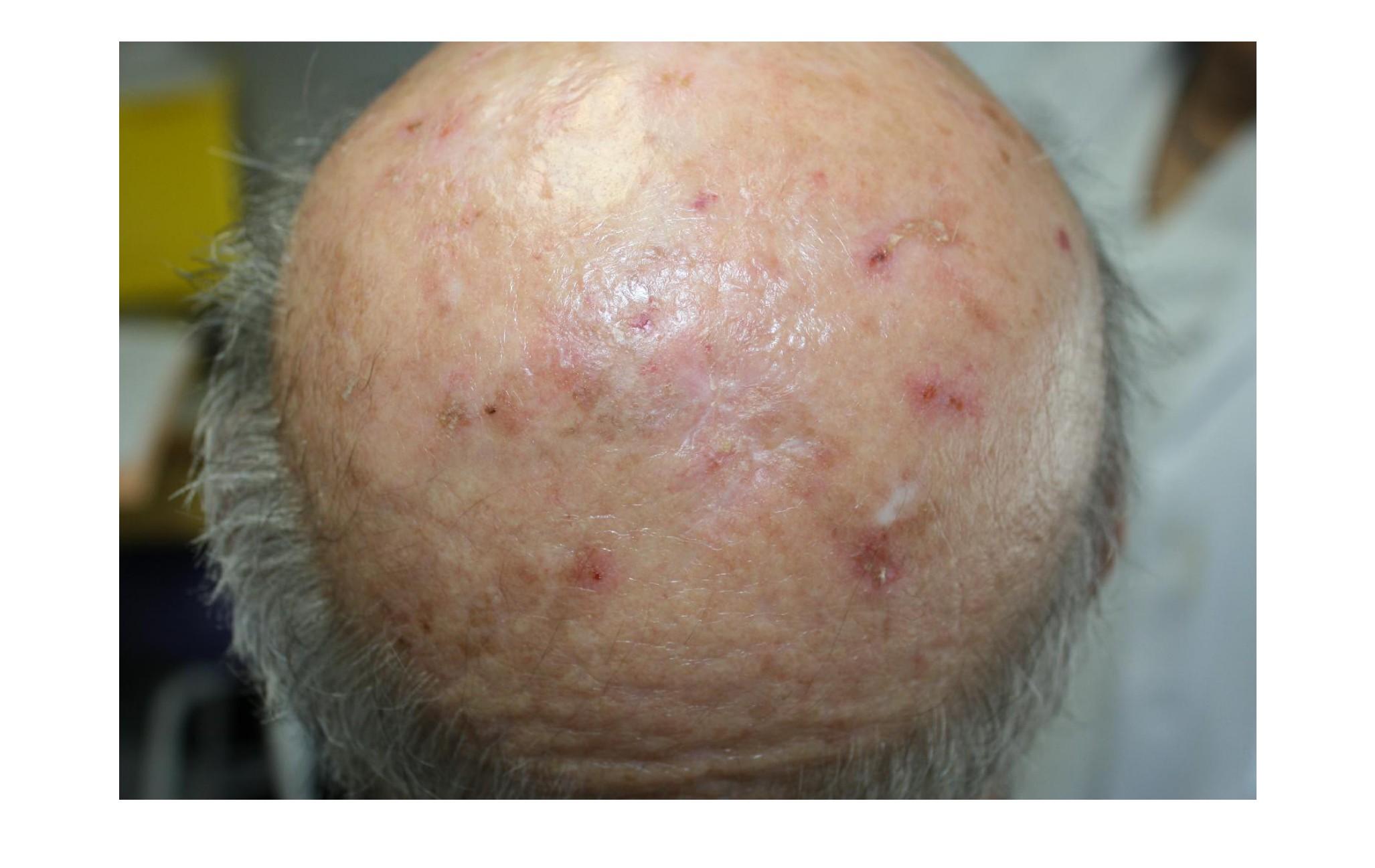 Imagen clínica de la pregunta de Dermatología