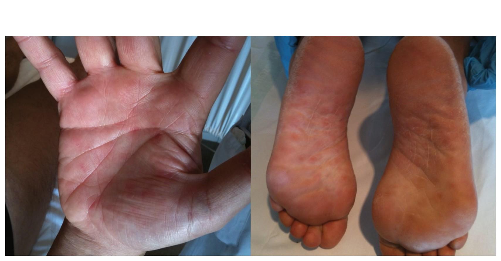 Imagen clínica de la pregunta de Infecciosas