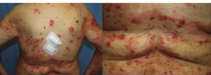 Imagen clínica de la pregunta de Dermatología