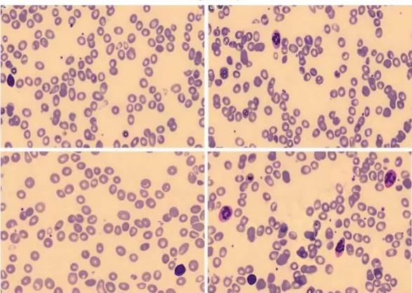 Imagen clínica de la pregunta de Hematología