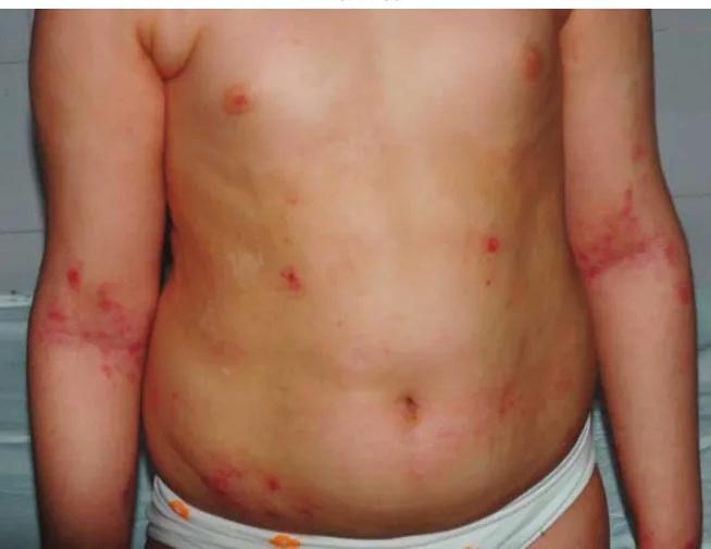 Imagen clínica de la pregunta de Dermatología