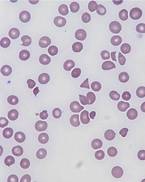Imagen clínica de la pregunta de Hematología