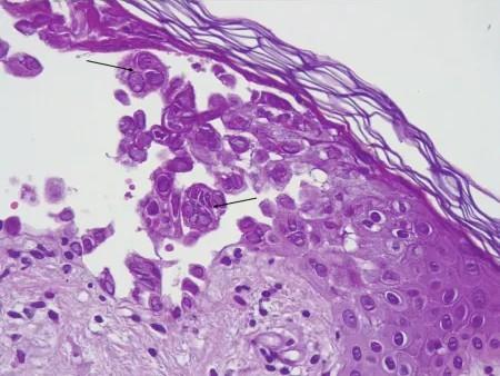 Imagen clínica de la pregunta de Dermatología