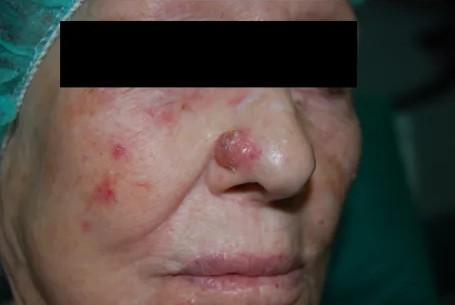 Imagen clínica de la pregunta de Dermatología